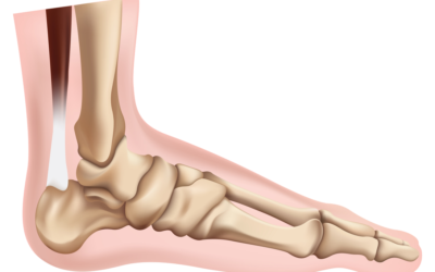 How Can You Treat Neuroma in the Feet?