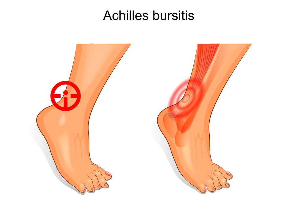How Long Does It Take for Achilles Bursitis to Heal Island Foot Clinics