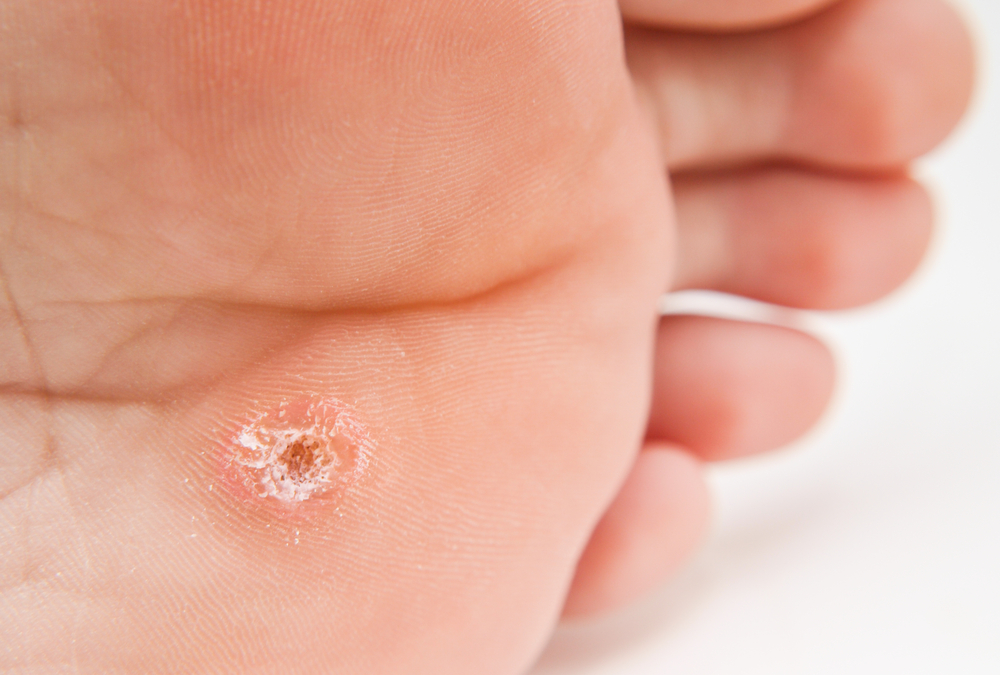 Plantar Wart vs. Callus: How to Tell the Difference