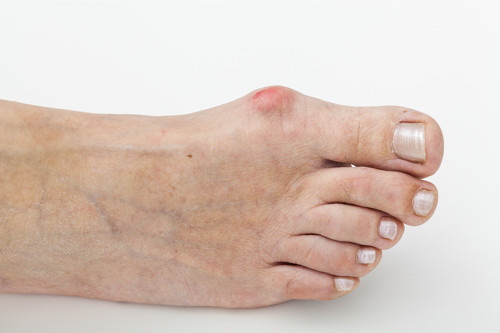 How Can You Fix Bunions Without Surgery?