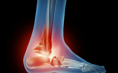 What Are the Causes of Arthritis in the Foot?